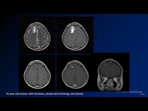 Intracranial infections - 5 - Other — video thumbnail