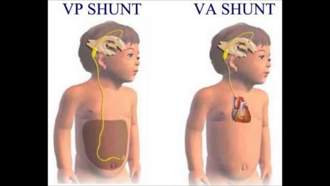 Шунт головного мозга