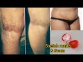 TOMATO & SUGAR TO REMOVE STUBBORN STRETCH MARKS | HOW TO FADE AWAY STRETCH MARKS & SCARS