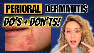 Perioral Dermatitis: The Rash Skincare May Be Making Worse | Dr. Shereene Idriss screenshot 3