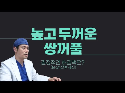 [MOTIVE Plastic Surgery] How to Fix High, Thick Eyelid Folds: The Ultimate Solution (feat. Before...