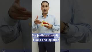 Sta Je Diskus Hernija, Kako Izgleda