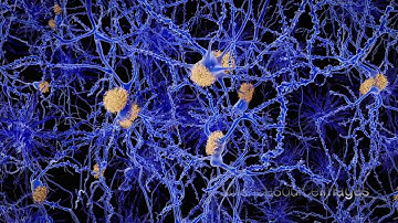 3D Animation of Neurons with amyloid plaques, cause of  Alzheimer