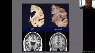 Huntington's disease Clinical Trial Update