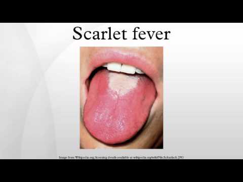 scarlet fever adult