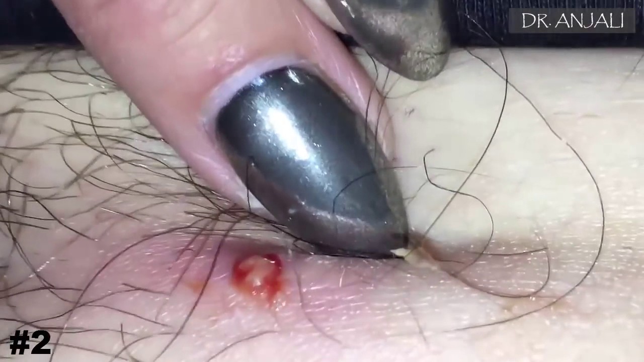 2 Top Removal Ingrown Hairs Pulling Out Ingrown Hair Youtube