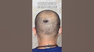 Get rid of post hair transplant scars #scalpmicropigmentation #smp #scalpdots