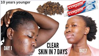 Use clove &amp; Colgate To Clear Skin From Acne Dark spots And beautiful Glowing skin fast