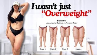I Have Stage 2 Lipoedema