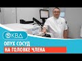 🙁 Опух сосуд на головке члена. Клинический случай №788