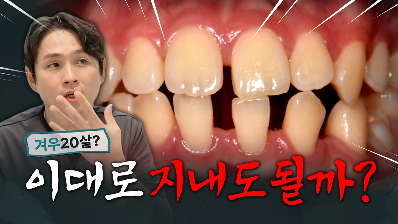 치아 사이 벌어진 틈 한 번에 해결! | 레진, 라미네이트❌