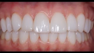 Виниры без обточки зубов. Noprep porcelain veneers. Carillas Dentales. 牙齿镶(Керамиеские виниры без препарирования зубов. Проведено устранение старой пломбы на правом центральном..., 2015-10-03T05:11:52.000Z)