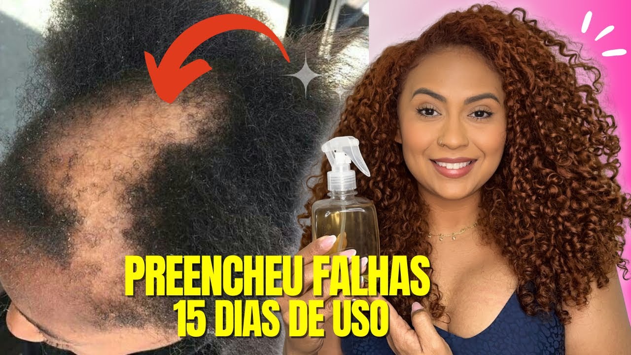 🔥 O cabelo cresce loucamente e não cai, esse é o melhor remédio. 4 ...