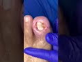 PARTE 2, uña muy encarnada #satisfying #ingrown_toenail