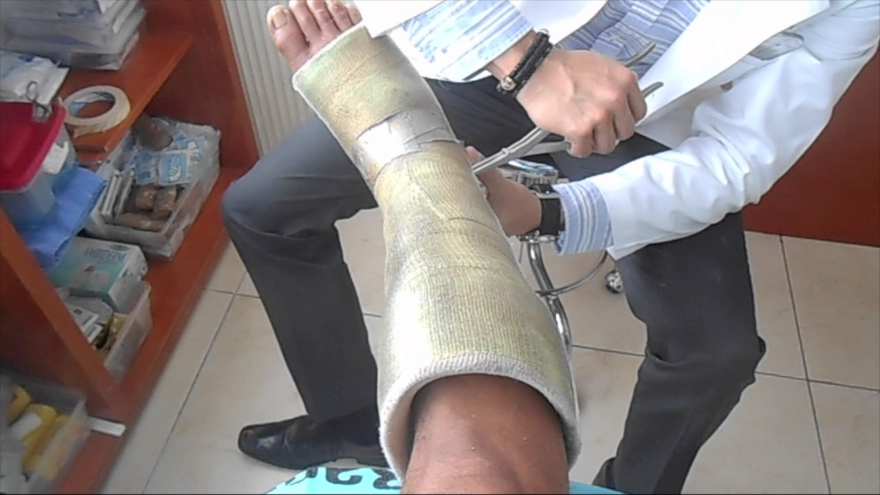  INICIANDO REHABILITACION DESPUES FRACTURA METATARSIANO
