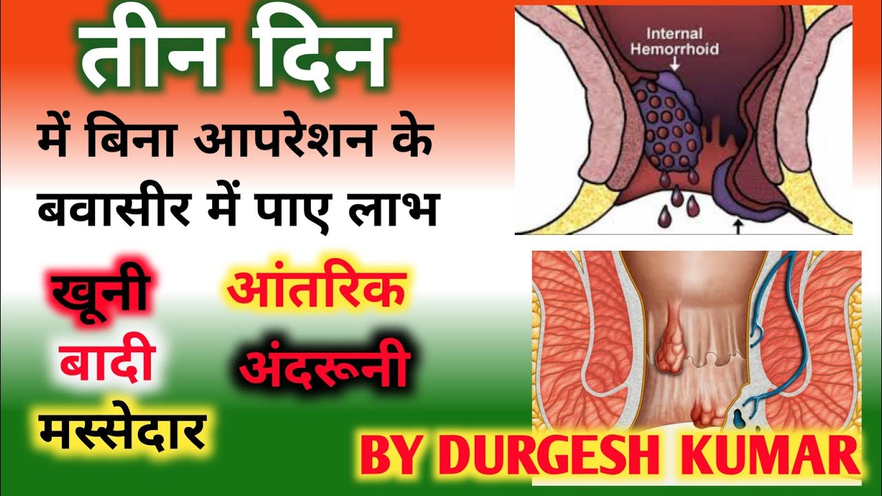 खूनी बवासीर, मस्सेदार बवासीर, बादी बवासीर तथा पुरानी से पुरानी बवासीर ...