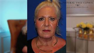 Neck Lift Blepharoplasty Testimonial Charlotte s Story Dr Sang Kim Natural Face Clinic