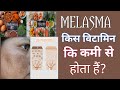 MELASMA किस विटामिन कि कमी से होता हैं? झाइयां क्यों ठीक नहीं हो रही हैं?