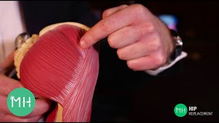 What are the different options for hip replacement?
