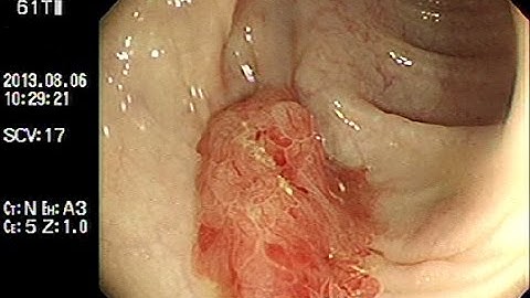 Cắt polyp đại tràng