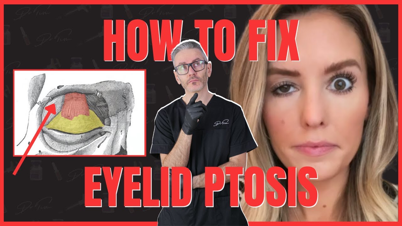 3 Ways to Fix Eyelid Ptosis After Botox