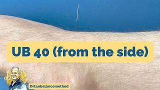 Bladder 40 (UB40) Needling Demo — Back Pain | Balance Method