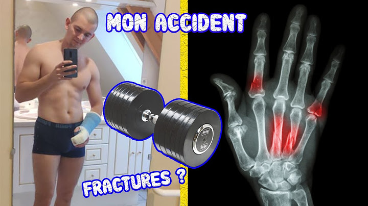 JE ME SUIS FRACTURÉ LA MAIN