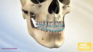 BSSO Mandibular Setback Bracket Profile