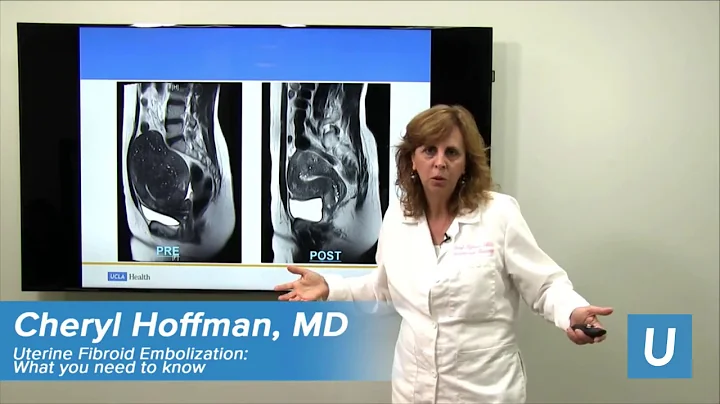 Uterine Fibroid Embolization | Cheryl Hoffman, MD ...