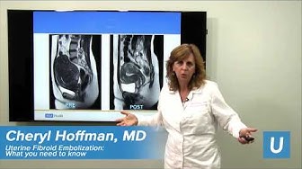 Uterine Leiomyoma Ct Scan • fibroid changes