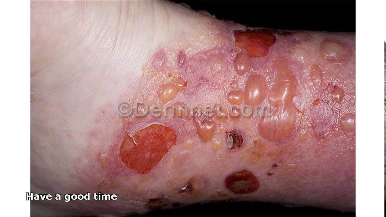 dermatitis 