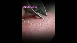 Relax Blackhead Removal 029  shorts   blackhead   acne   pimplesremoval   satisfying