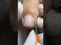 Impacted or Ingrown Toenail Pedicure #short #shorts
