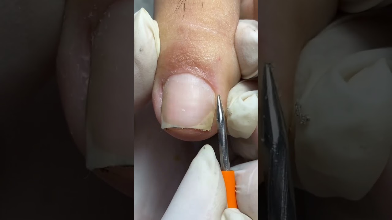 Impacted or Ingrown Toenail Pedicure #short #shorts