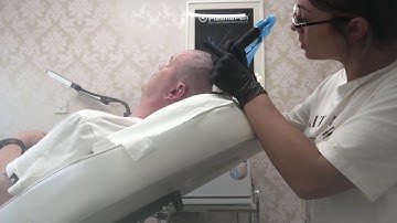 Scalp Micropigmentation In Action