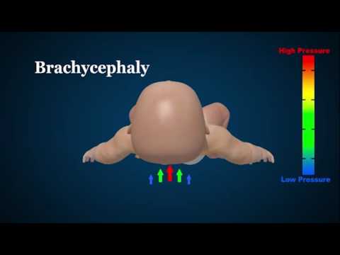 Video: Flat Head Baby (Plagiozephalie): Symptome, Ursachen, Behandlung