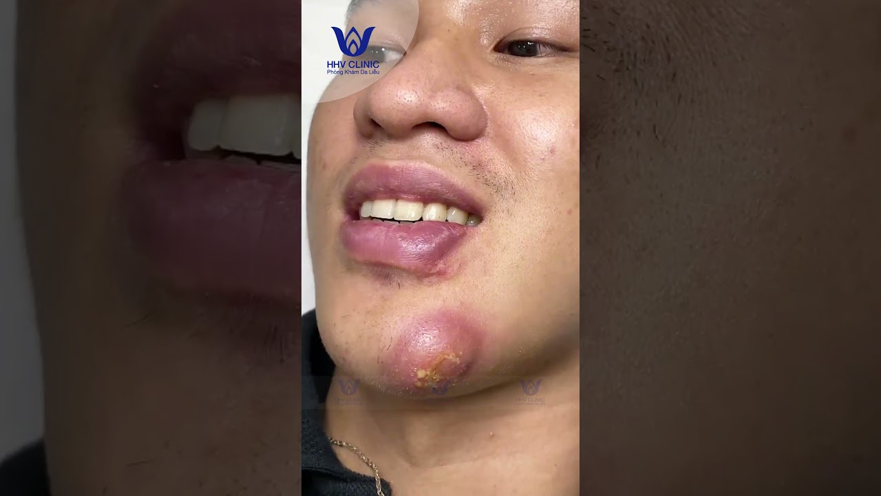 ÁP XE CẰM VIÊM NẶNG KHÁCH KHÔNG DÁM CHẠM VÌ QUÁ ĐAU.