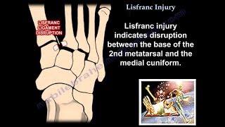 Lisfranc Injury - Everything You Need To Know - Dr. Nabil Ebraheim