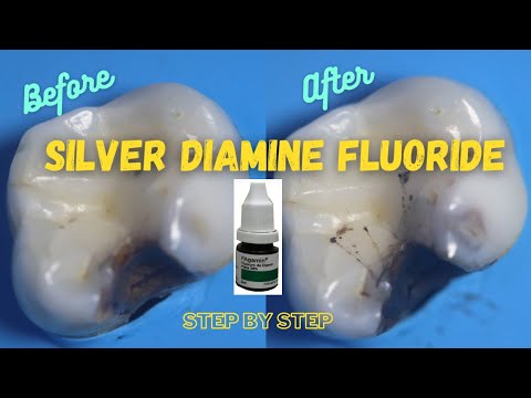 Video: Silver Diamine Fluoride: Bivirkninger, Kostnader Og Oral Hygiene