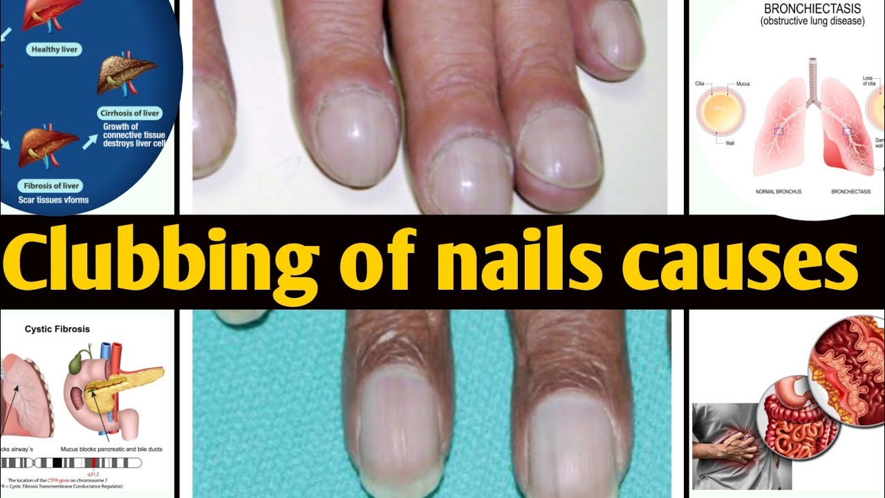 Clubbing of nails causes in hindi//नेल क्लबिंग के कारण YouTube