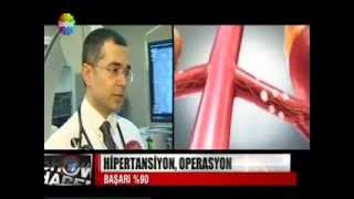 Renal Denervasyon ile Hipertansiyona Çözüm