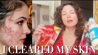How I Cleared My Acne Naturally