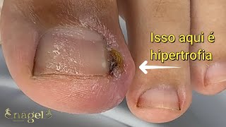 😱 ELE JÁ ESTAVA HÀ 1 MES ASSIM, COM MUITA DOR! (pá do ar condicionado c/ barulho)  #nail #satisfying