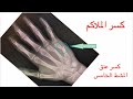 Boxer S Fracture كسر الملاكم أو كسر عنق المشط الخامس لليد 