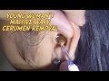 Young Woman's Massive Waxy Cerumen Removal