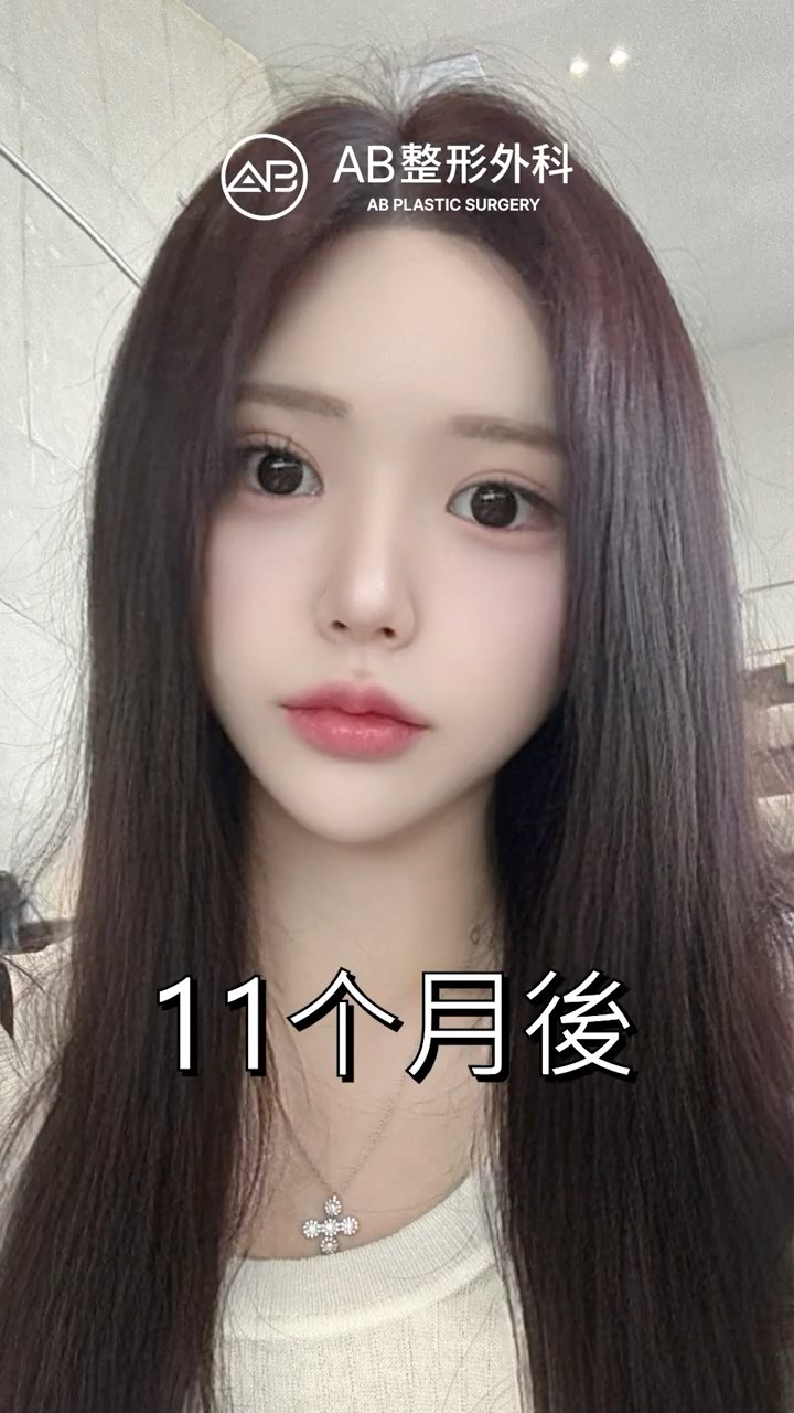 臉部輪廓手術後變得更漂亮了✨ #Shorts