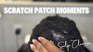 Dandruff Scratch Patch Moments Wealth