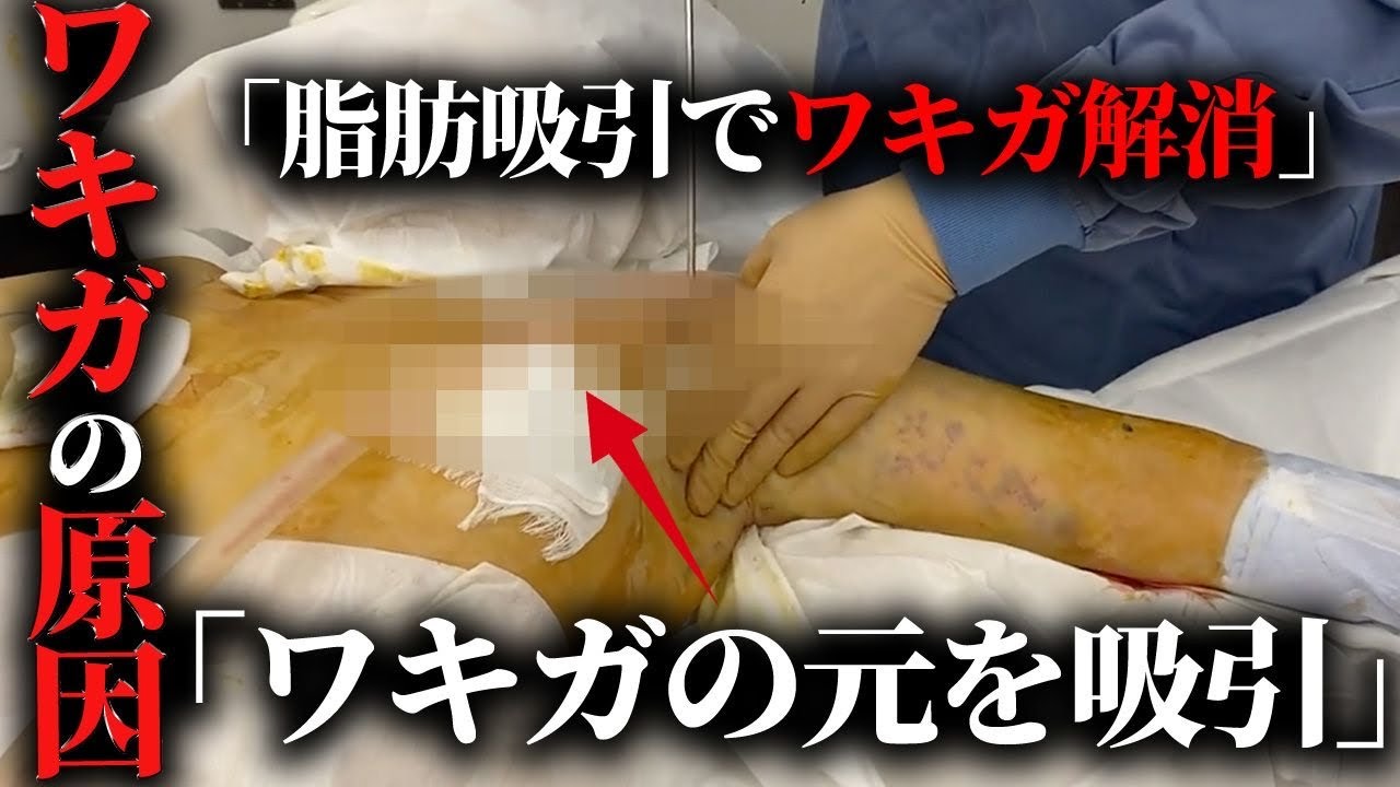 ワキガ 手術 失敗 死亡