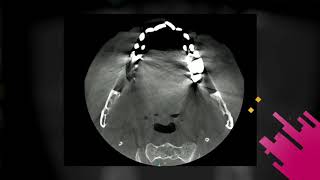 CS 8200 3D With Metal Artifact Reduction