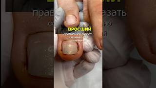 Вросший ноготь # вросшиеногти #педикюрсевастополь #педикюр #натальякаст #севастополь